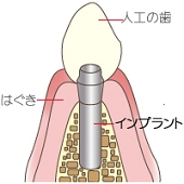 栃木県宇都宮市ハートフルにわの歯科医院 インプラント