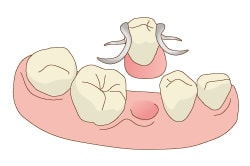 部分入れ歯