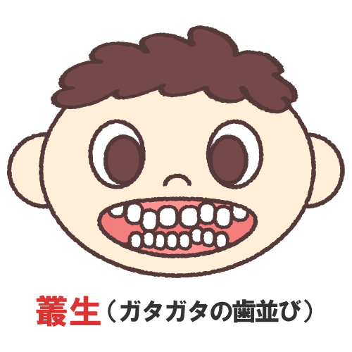 叢生ガタガタの歯並び