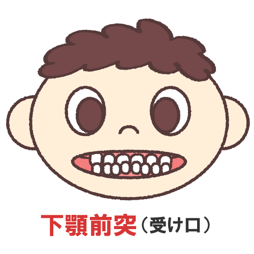 下顎前突受け口
