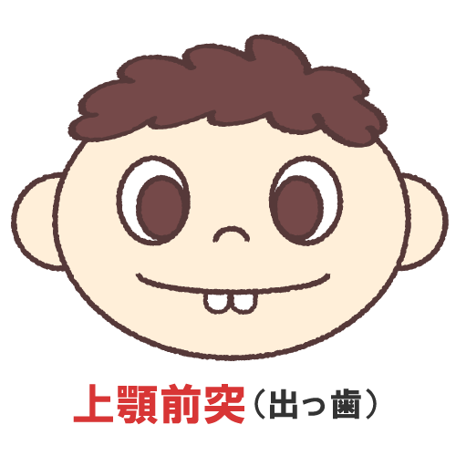上顎前突出っ歯