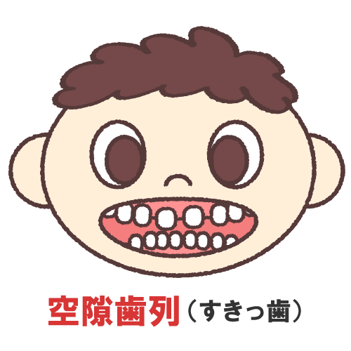 空隙歯列すきっ歯