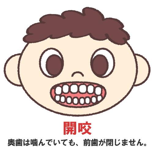 開咬